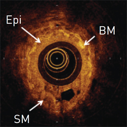 Bronchial thermoplasty in asthma: 2-year follow-up using optical coherence tomography