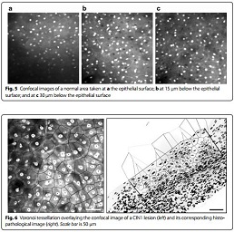 Quantification of confocal fluorescence microscopy for the detection of cervical intraepithelial neoplasia