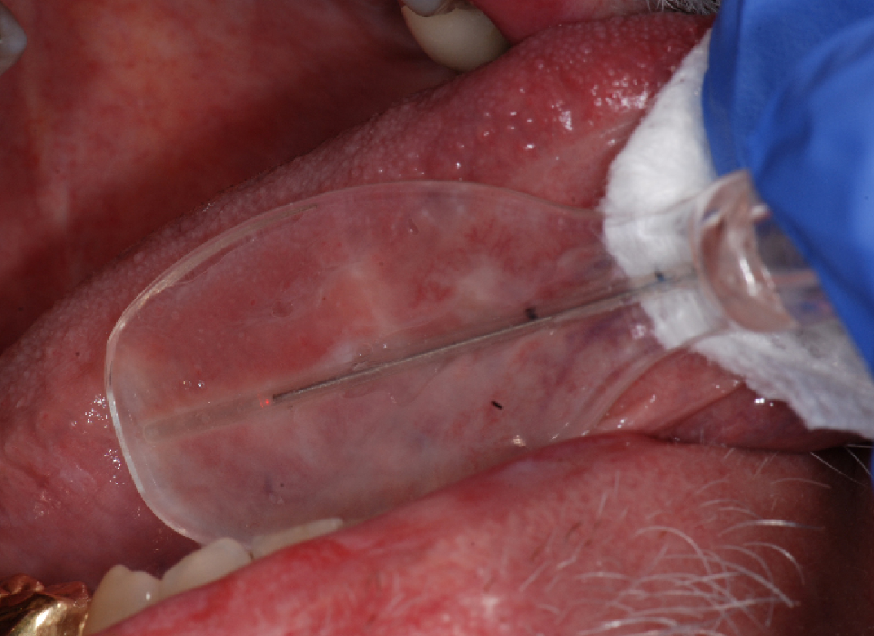 dental-mirror-catheter