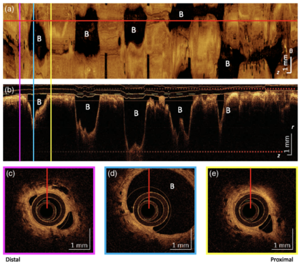 Small airway dilation measured by endoscopic optical coherence tomography correlates with chronic lung allograft dysfunction