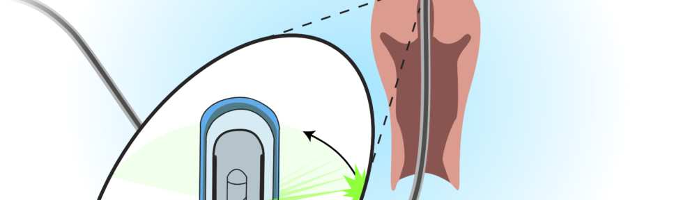 Endocervical Cancer Screening Study