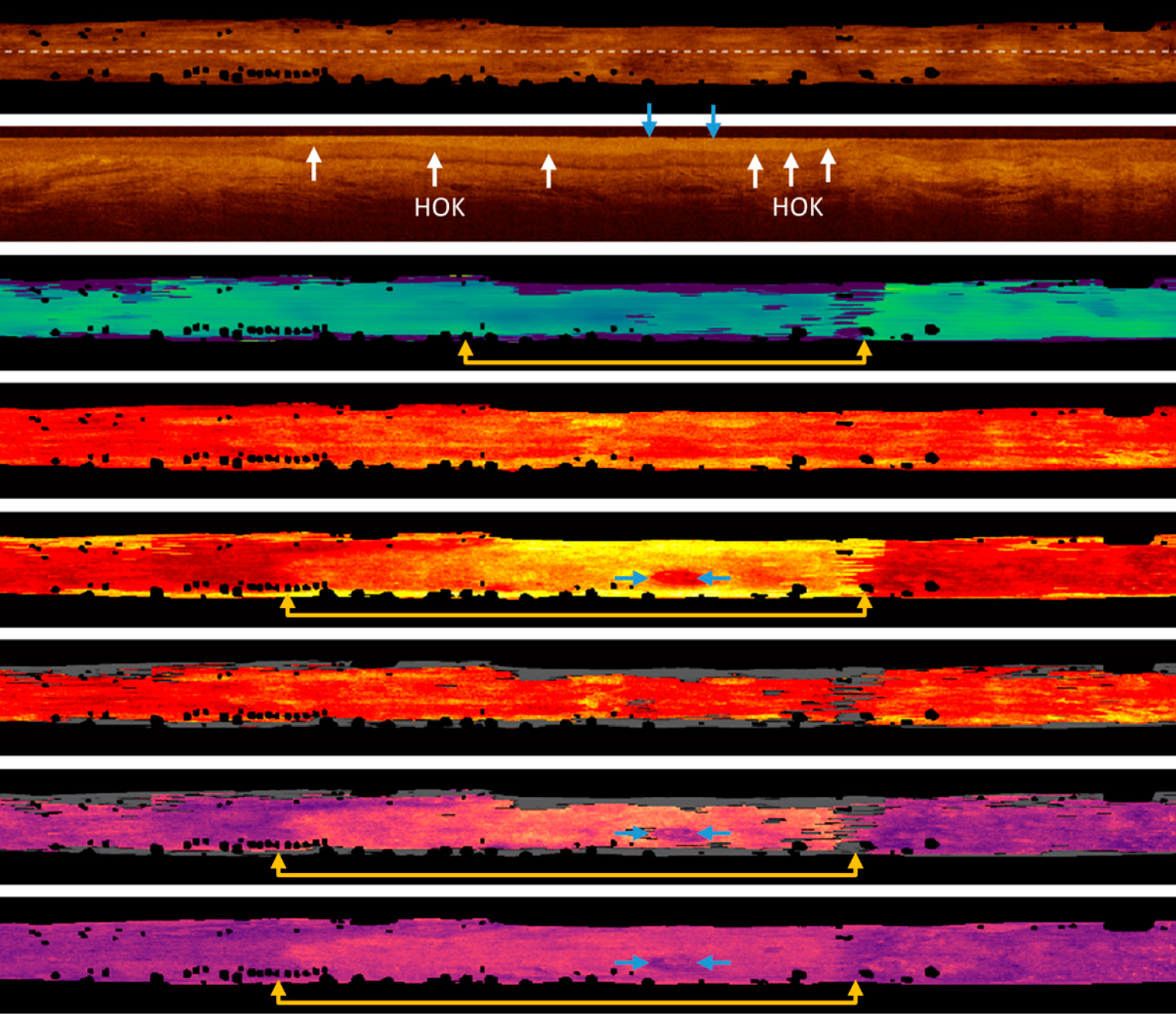 Imaging Biomarkers of Oral Dysplasia and Carcinoma Measured with In Vivo Endoscopic Optical Coherence Tomography